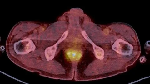 A PET-CT scan image is a diagnostic visualization combining Positron Emissi.. Stock Illustration
