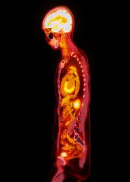 A PET-CT scan image is a diagnostic visualization combining Positron Emissi.. Stock Illustration