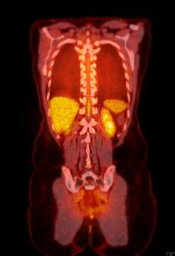 A PET-CT scan image is a diagnostic visualization combining Positron Emissi.. Stock Illustration