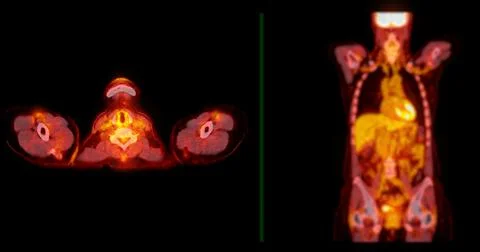 A PET-CT scan image is a diagnostic visualization combining Positron Emissi.. Stock Illustration