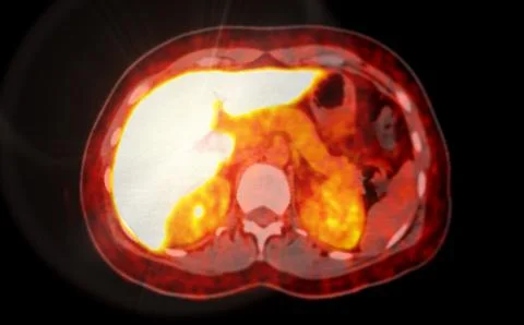 A PET-CT scan image is a diagnostic visualization combining Positron Emissi.. Stock Illustration