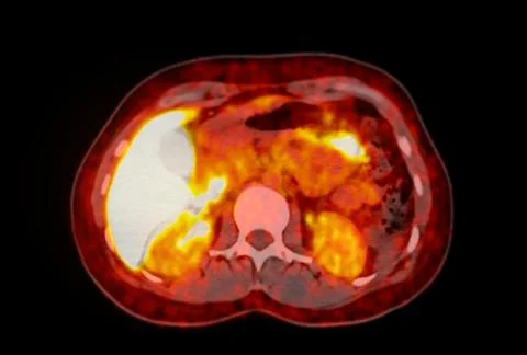 A PET-CT scan image is a diagnostic visualization combining Positron Emissi.. Stock Illustration