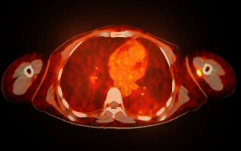 A PET-CT scan image is a diagnostic visualization combining Positron Emissi.. Illustrazione stock