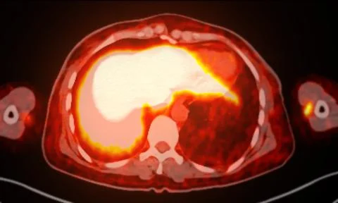 A PET-CT scan image is a diagnostic visualization combining Positron Emissi.. Illustrazione stock