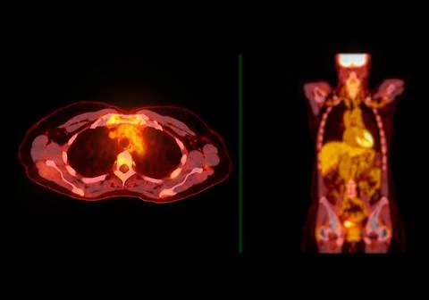 A PET-CT scan image is a diagnostic visualization combining Positron Emissi.. Stock Illustration
