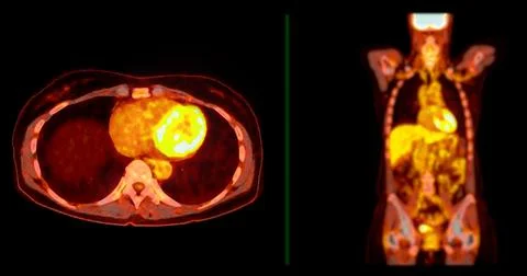 A PET-CT scan image is a diagnostic visualization combining Positron Emissi.. Stock Illustration