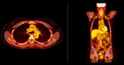 A PET-CT scan image is a diagnostic visualization combining Positron Emissi.. Stock Illustration