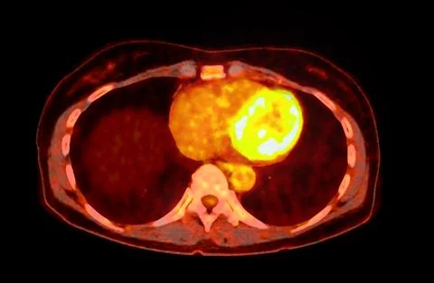A PET-CT scan image is a diagnostic visualization combining Positron Emissi.. Illustrazione stock