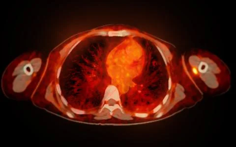 A PET-CT scan image is a diagnostic visualization combining Positron Emissi.. Stock Illustration