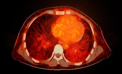 A PET-CT scan image is a diagnostic visualization combining Positron Emissi.. Stock Illustration