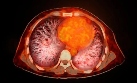 A PET-CT scan image is a diagnostic visualization combining Positron Emissi.. Illustrazione stock