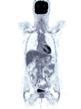 A PET-CT scan image is a diagnostic visualization combining Positron Emissi.. Stock Illustration