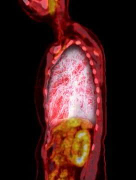 A PET-CT scan image is a diagnostic visualization combining Positron Emissi.. Stock Illustration