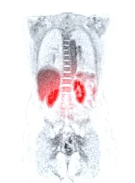 A PET-CT scan image is a diagnostic visualization combining Positron Emissi.. Stock Illustration