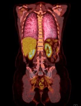 A PET-CT scan image is a diagnostic visualization combining Positron Emissi.. Illustrazione stock
