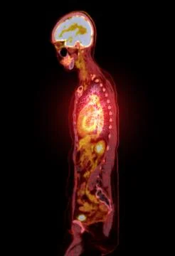 A PET-CT scan image is a diagnostic visualization combining Positron Emissi.. Stock Illustration
