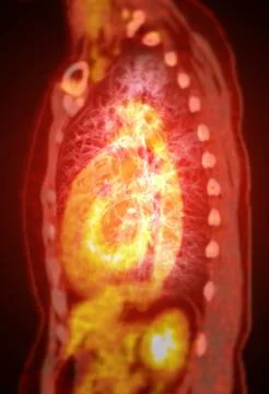 A PET-CT scan image is a diagnostic visualization combining Positron Emissi.. Stock Illustration