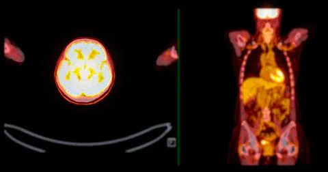 A PET-CT scan image is a diagnostic visualization combining Positron Emissi.. Illustrazione stock