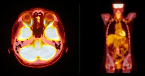 A PET-CT scan image is a diagnostic visualization combining Positron Emissi.. Stock Illustration