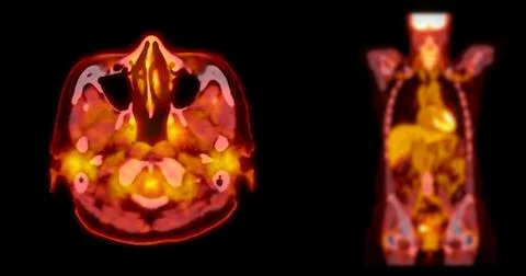 A PET-CT scan image is a diagnostic visualization combining Positron Emissi.. Stock Illustration