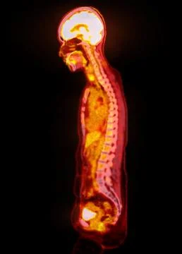 A PET-CT scan image is a diagnostic visualization combining Positron Emissi.. Stock Illustration