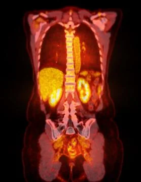 A PET-CT scan image is a diagnostic visualization combining Positron Emissi.. Stock Illustration