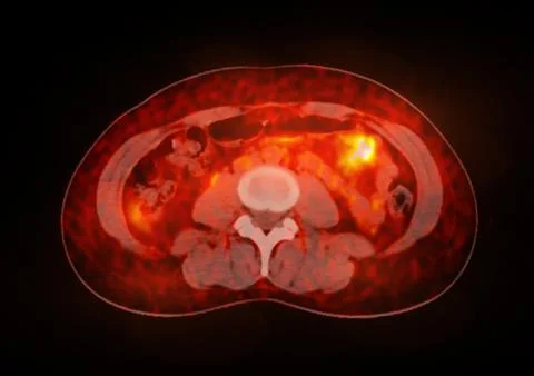 A PET-CT scan image is a diagnostic visualization combining Positron Emissi.. Stock-Illustration