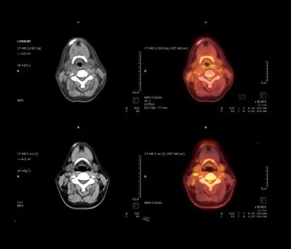 PET CT Scan image of Neck in axial plane comparison CT scan and PET CT for de Stock Illustration