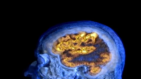 PET Imaging of Brain Stock Footage 90866342