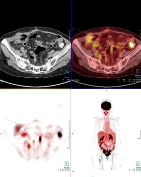 PET Scan image of abdomen for detect lung cancer recurrence after surgery. me Stock Illustration