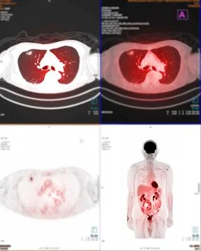 PET Scan image of thorax or chest  Comparison Axial , Coronal  for detect lun Stock-Illustration
