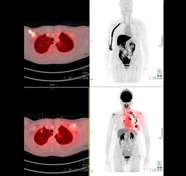 PET Scan image of thorax or chest  Comparison Axial , Coronal  for detect lun Stock Illustration