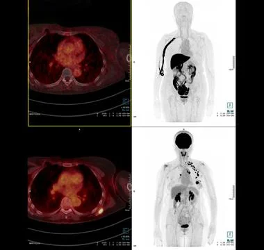 PET Scan image of thorax or chest  Comparison Axial , Coronal  for detect lun Stock Illustration