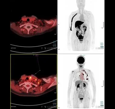 PET Scan image of thorax or chest  Comparison Axial , Coronal  for detect lun Stock Illustration