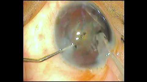 Phacoemulsification Cataract surgery for the human eye Stock Footage 284506637