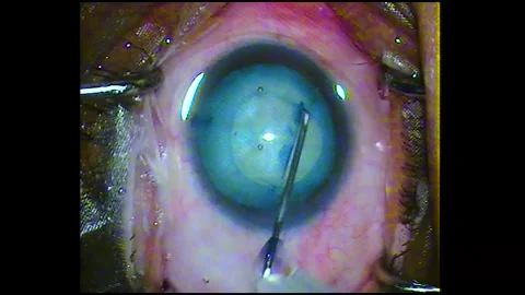 Phacoemulsification Cataract surgery for the human eye Stock Footage 284508542