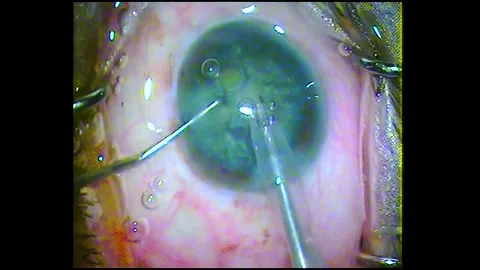 Phacoemulsification Cataract surgery for the human eye Stock Footage 284509603