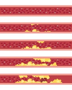 Phases of atherosclerosis vector illustration Stock Illustration