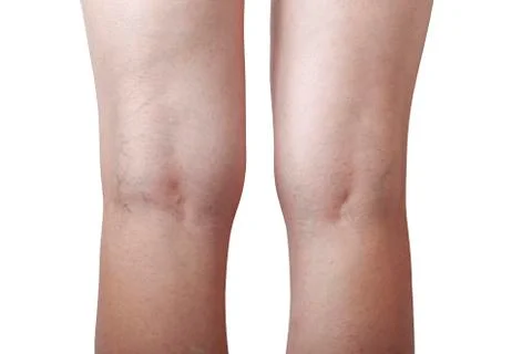 The phlebeurysm on legs Photos