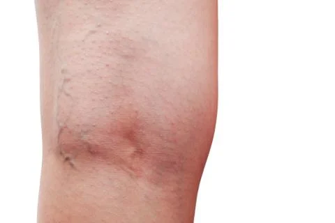 The phlebeurysm on legs Stock Photos