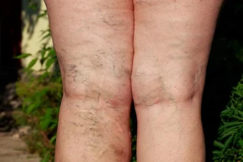 The phlebeurysm on legs 库存照片