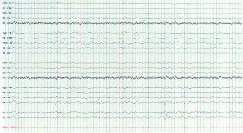 Photography of sharp wave during interictal EEG in epilepsy Stock Photos
