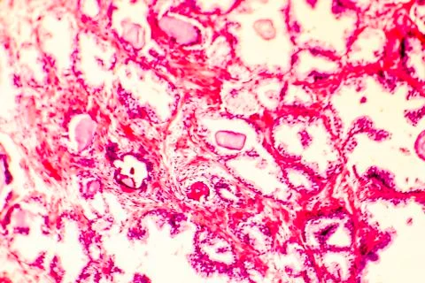 Photomicrograph of prostate hyperplasia Stock Illustration