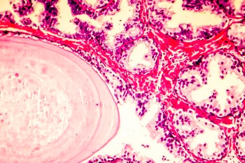 Photomicrograph of prostate hyperplasia Stock Illustration