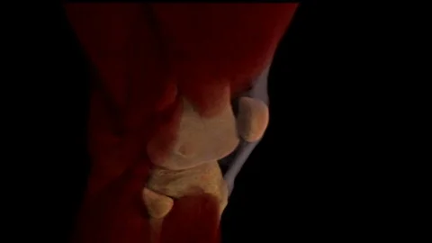 Physical Effects of Osteoarthritis Video stock 113228267