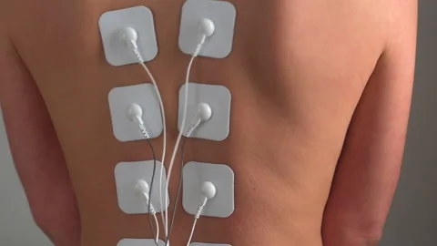 Physiotherapy of the back with TENS myostimulator, electrical nerve stimulation. Stock Footage 150649214