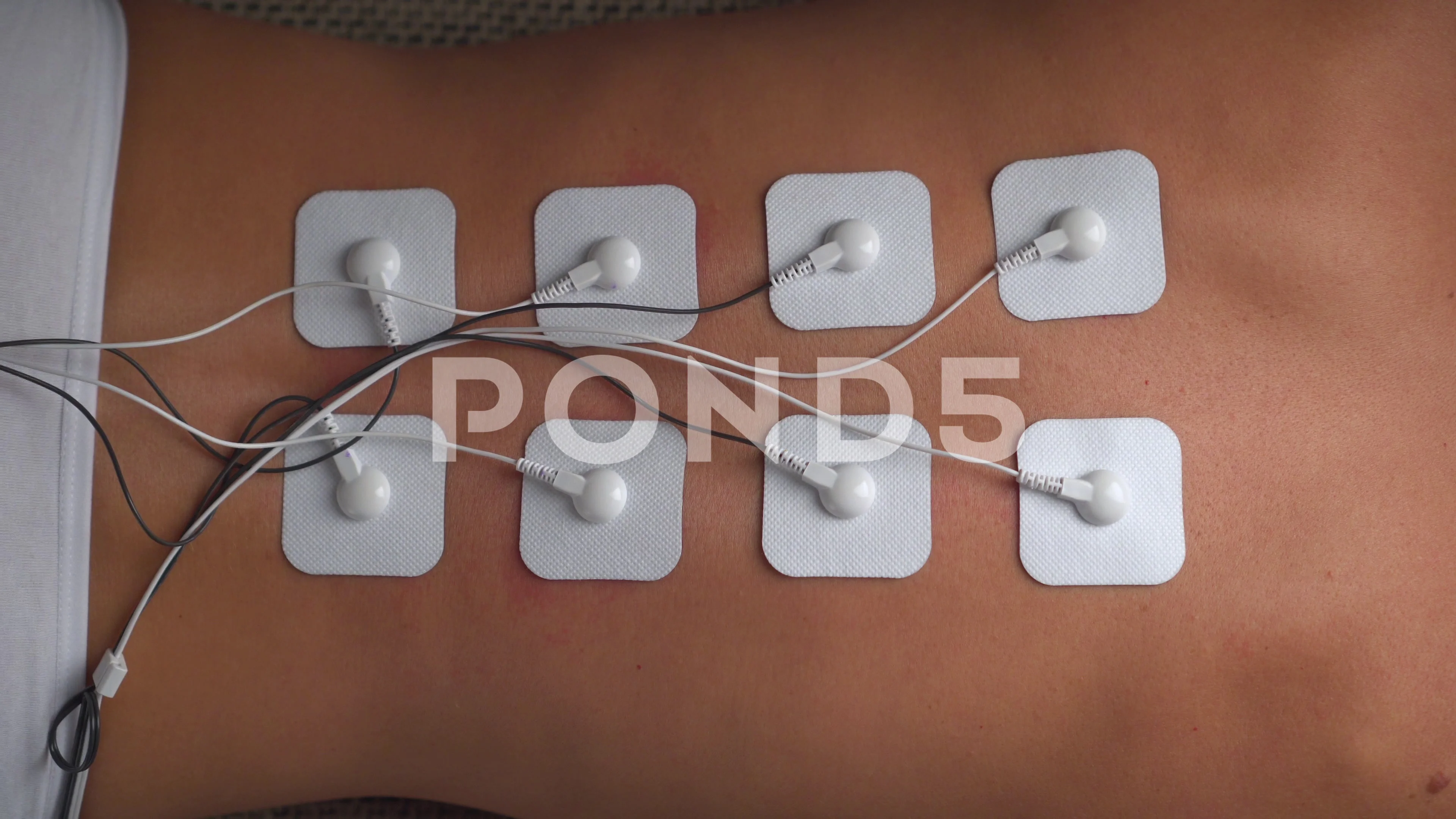 Lower Back Physical Therapy with TENS Electrode Pads, Transcutaneous  Electrical Nerve Stimulation Stock Photo