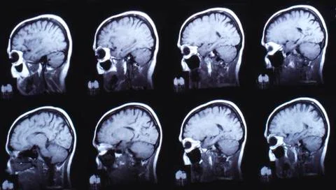 Picture of computed tomography the brain. black and white. Stock Photos