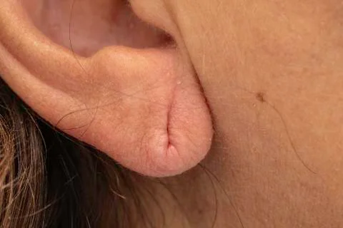 Pierced earlobe close up, stretched external ear skin with former piercing ho Stock Photos