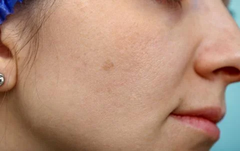 Pigmentation on the skin. Stock Photos